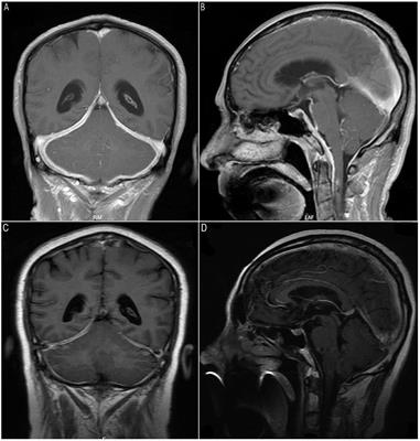 IgG4-related hypertrophic pachymeningitis with ANCA-positivity: A case series report and literature review